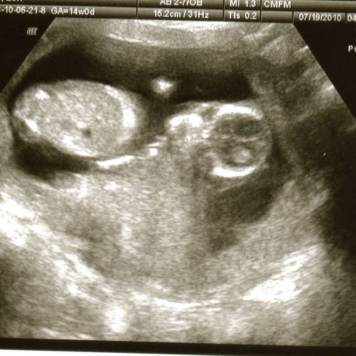 14 week fetal development